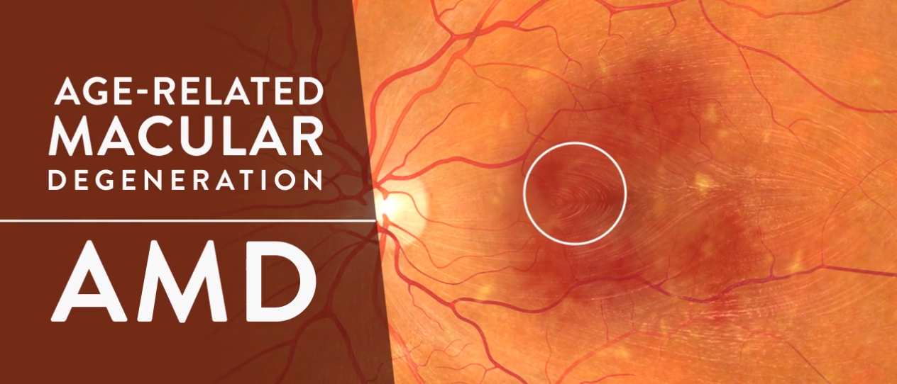 AgeRelated Macular Degeneration (AMD) Beyond Aging Eyes Carrot